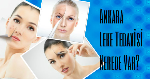 Ankara leke tedavisi nerede var?