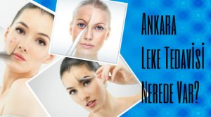Ankara Leke Tedavisi Nerede Var?